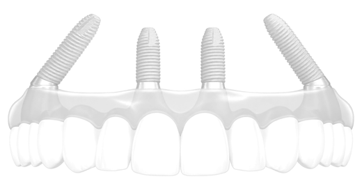 All-on-4 protezo ir keturių implantų iliustracija